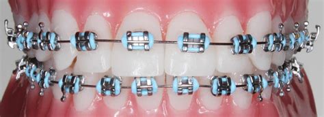 metal ortho brackets|pictures of traditional steel braces.